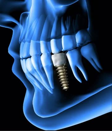Implant image